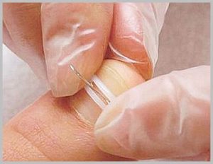 Лечение вросшего ногтя без операции (ортониксия)